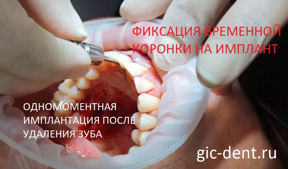 Фиксация временной коронки на имплант при одномоментном удалении и имплантации переднего зуба